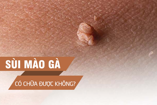 Sui-mao-ga-co-chua-duoc-khong-5