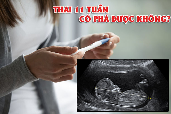 Có thể phá thai 11 tuần tuổi hay không?