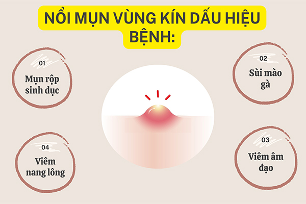 Nổi mụn vùng kín - Dấu hiệu bệnh lý chị em chớ chủ quan