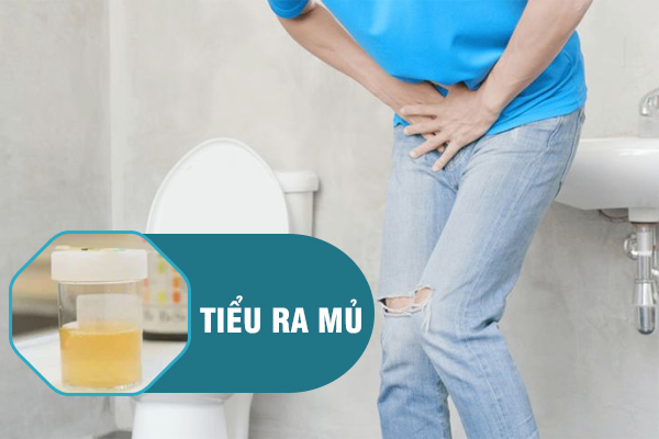 Tiểu ra mủ là bị bệnh gì? Có nguy hiểm không?