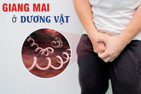 Giang mai ở dương vật: Dấu hiệu và cách điều trị hiệu quả 