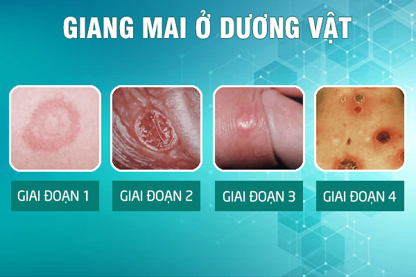 Benh-giang-mai-o-duong-vat-5