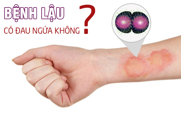 Mắc bệnh lậu có đau ngứa không?