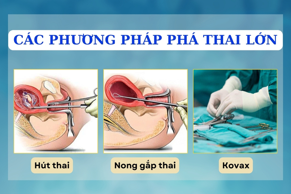 Các phương pháp phá thai lớn