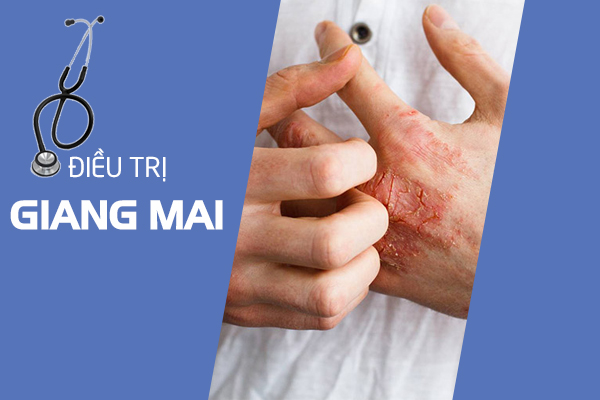 Cách chữa bệnh giang mai hiệu quả, giảm khả năng tái phát