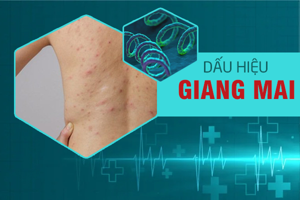 Dấu hiệu & biểu hiện giang mai chớ xem thường 