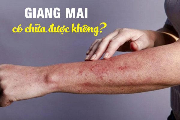 Bệnh giang mai chữa được không? Địa chỉ điều trị bệnh hiệu quả