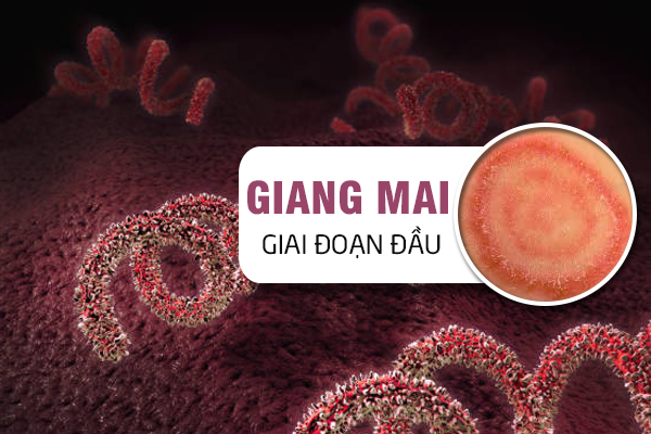 Giang mai giai đoạn đầu: Biểu hiện nhận biết và cách chữa trị