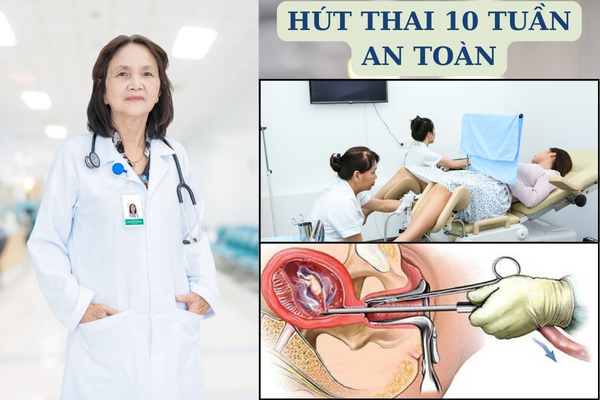 Hút thai 10 tuần