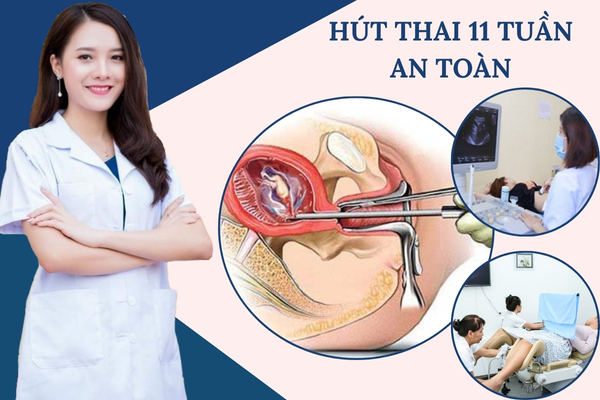 Hút thai 11 tuần