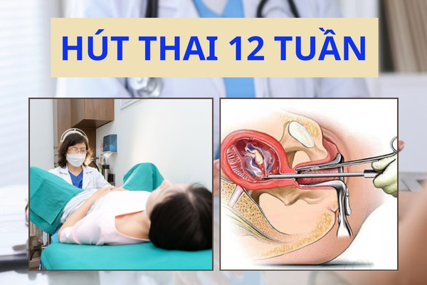 Phương pháp hút thai 12 tuần là gì? Địa chỉ phá thai an toàn tại Hải Dương