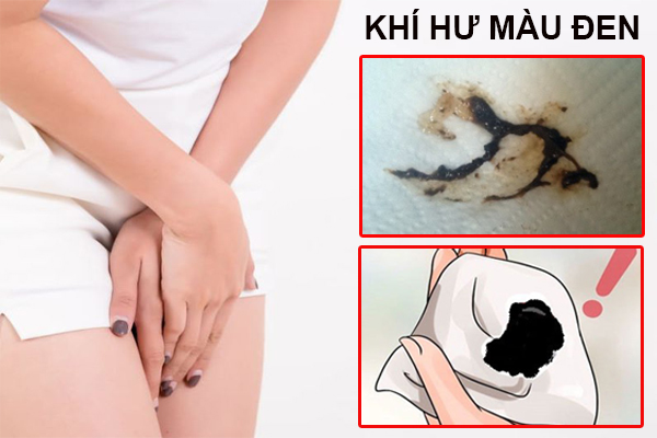 Ra khí hư màu đen – Nguyên nhân do đâu?