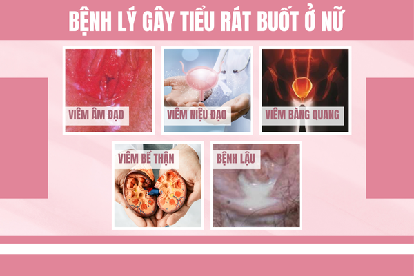 Trieu-chung-tieu-rat-buot-o-nu-can-canh-giac-1