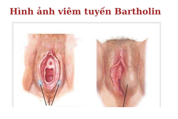 Viem-tuyen-bartholin (3)