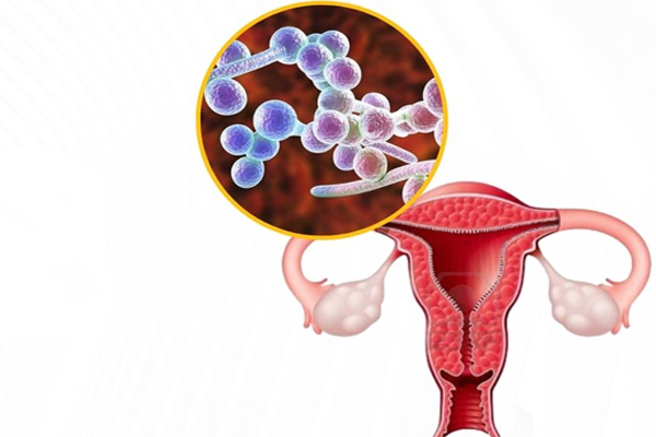 Nhiễm nấm âm đạo, nữ giới đừng nên chủ quan!