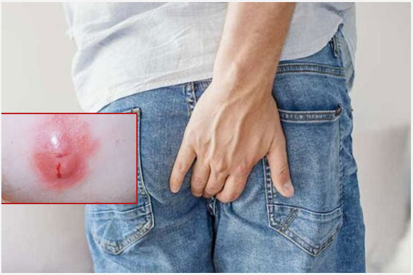 Áp xe hậu môn: Triệu chứng và Cách khắc phục hiệu quả