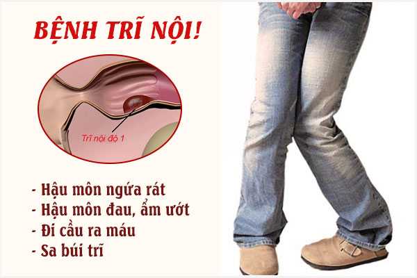 Bệnh trĩ nội ở nam và nữ giới: Nguyên nhân, biểu hiện và mức độ nguy hiểm
