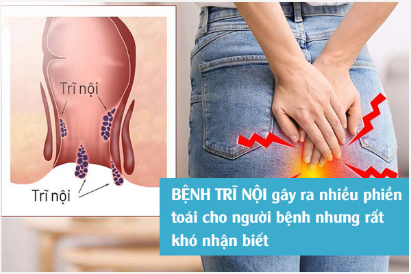 Bệnh trĩ nội là gì? Những điều cần biết về bệnh trĩ nội