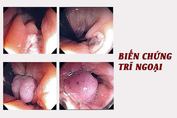 Bien-chung-tri-ngoai