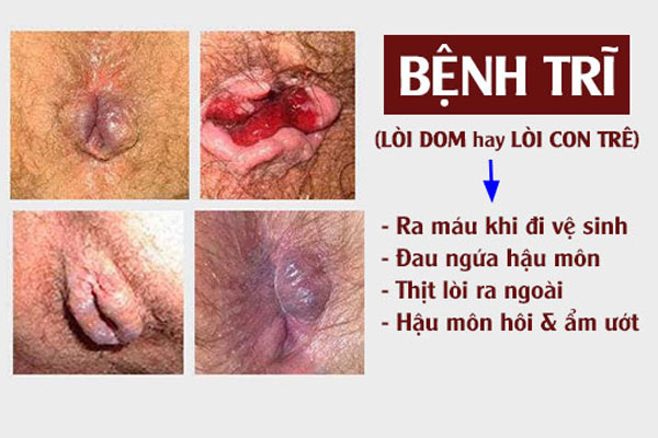 Bieu-hien-benh-tri