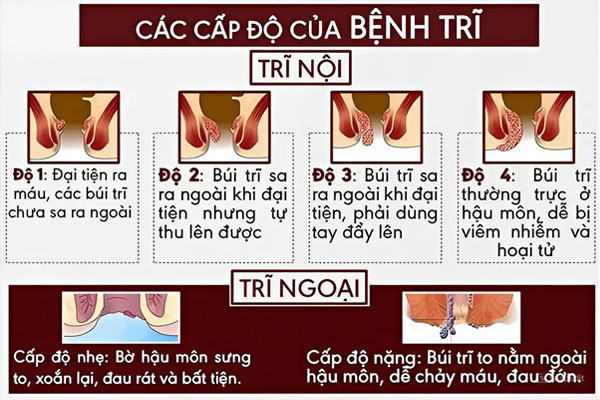 Cac-cap-do-benh-tri