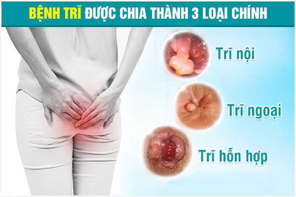 Bệnh trĩ là gì? Nguyên nhân, Triệu chứng và Nguy hiểm của bệnh