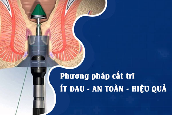 Phẫu thuật cắt trĩ hiệu quả – về liền trong ngày tại Đa khoa Trường Hải