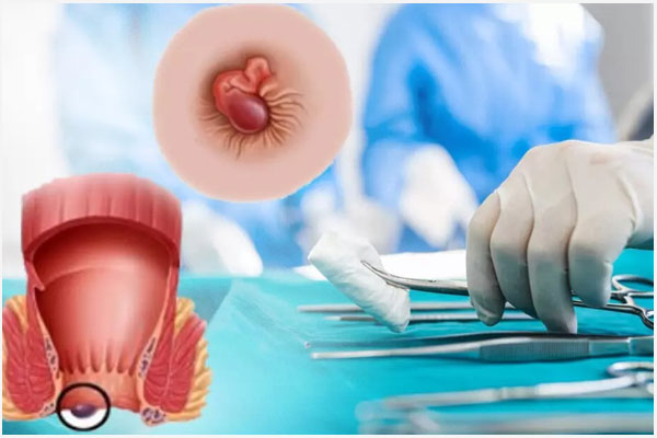 Cắt trĩ nội có đau không? Cắt trĩ nội ở đâu tốt?