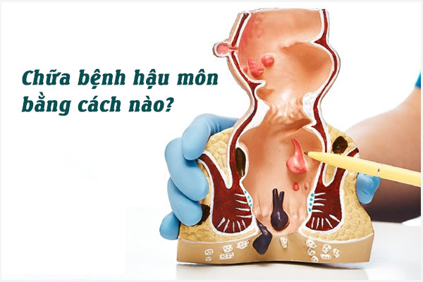 Phương pháp chữa bệnh hậu môn hiệu quả