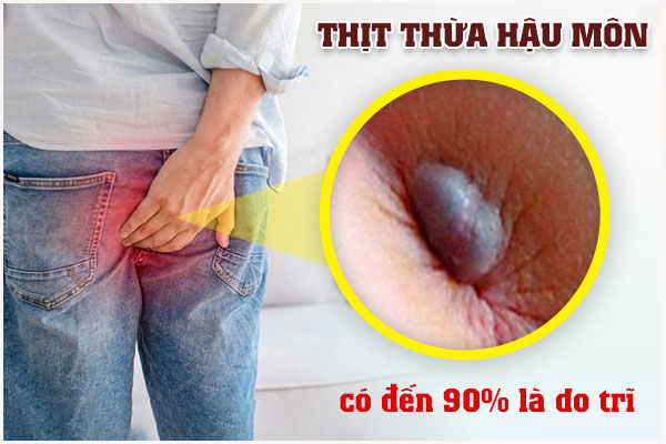 Nổi cục thịt thừa ở hậu môn là bệnh gì?