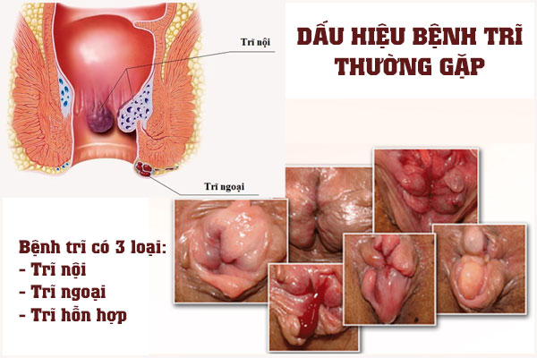 Dau-hieu-benh-tri