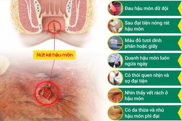 Dau-hieu-nut-ke-hau-mon