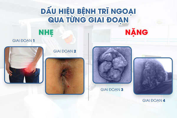 Dau-hieu-tri-ngoai