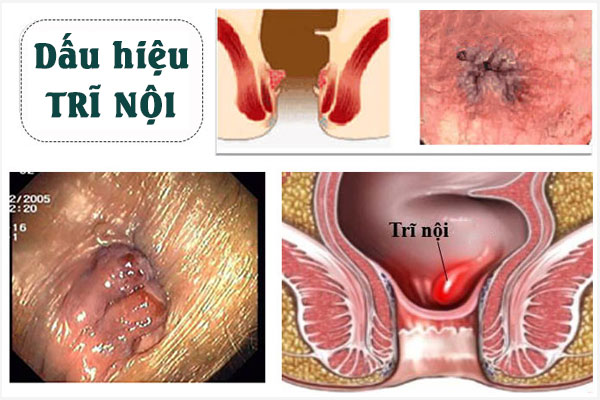 Dau-hieu-tri-noi