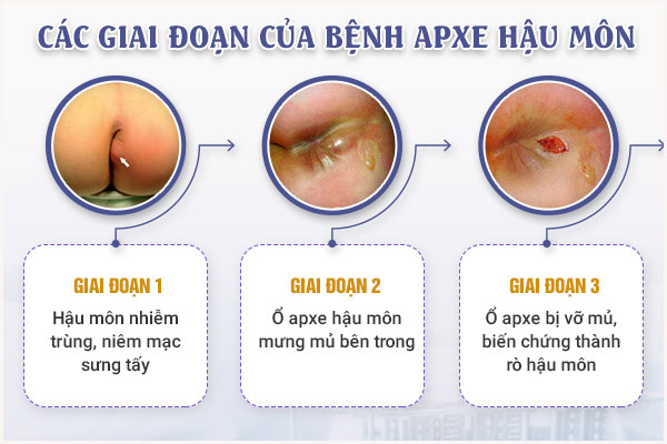 Giai-doan-apxe-hau-mon