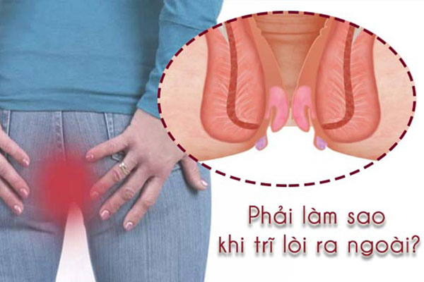 Bệnh trĩ ngoại ở nam và nữ giới: Hình ảnh, Biểu hiện và Cách chữa
