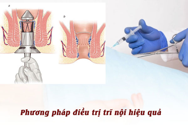 Phương pháp hỗ trợ điều trị trĩ nội hiệu quả