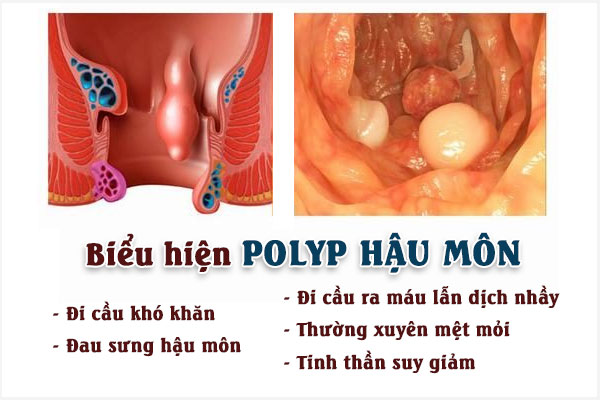 Polyp-hau-mon