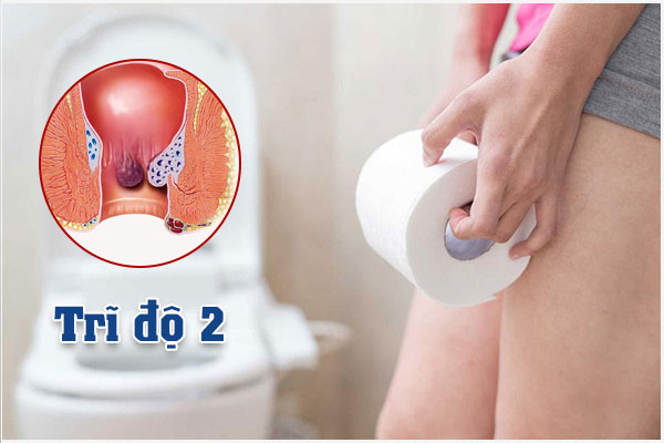 Bệnh trĩ cấp độ 2: Triệu chứng và Cách điều trị