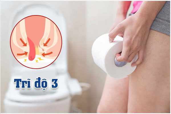 Bệnh trĩ cấp độ 3: Triệu chứng và Cách điều trị