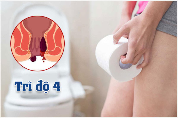 Bệnh trĩ cấp độ 4: Triệu chứng và Cách điều trị