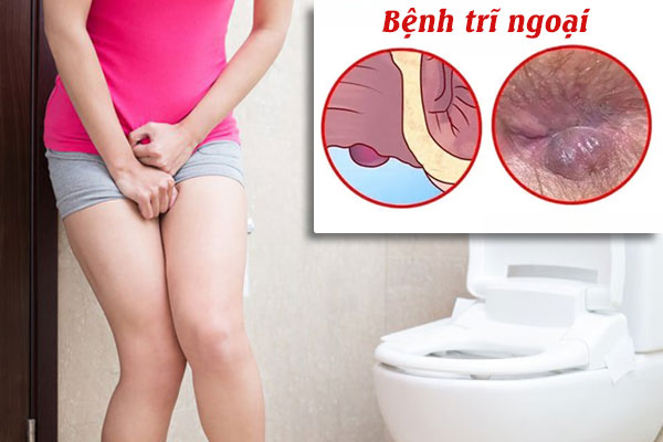Dấu hiệu nhận biết bệnh trĩ ngoại