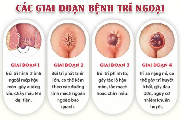Tri-ngoai