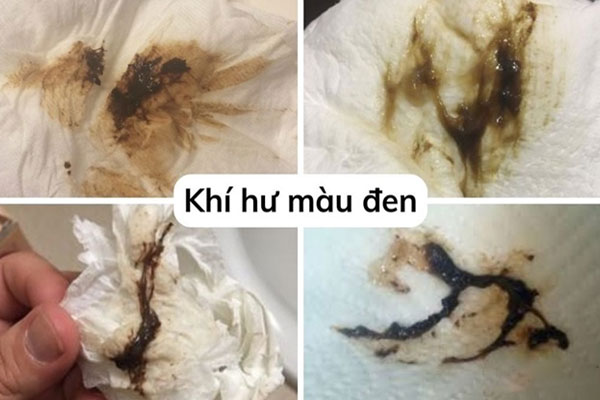 Huyet-trang-mau-den-3