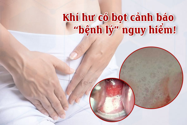 Âm đạo ra nhiều khí hư có bọt là do đâu? Cách khắc phục hiệu quả