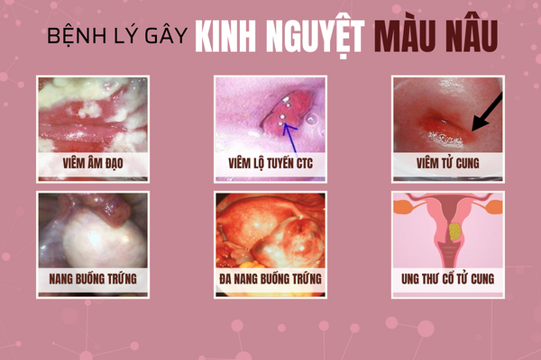 Kinh-nguyet-mau-nau-1