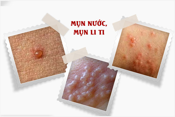 Âm đạo nổi mụn li ti là bị gì? Có nguy hiểm không?