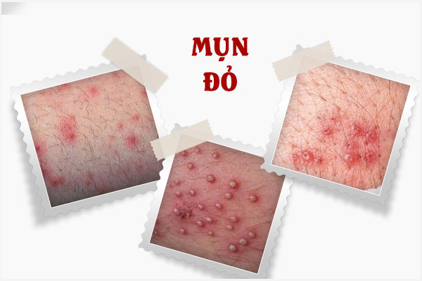 Nổi mụn đỏ âm đạo là bị gì? Làm sao để hết?