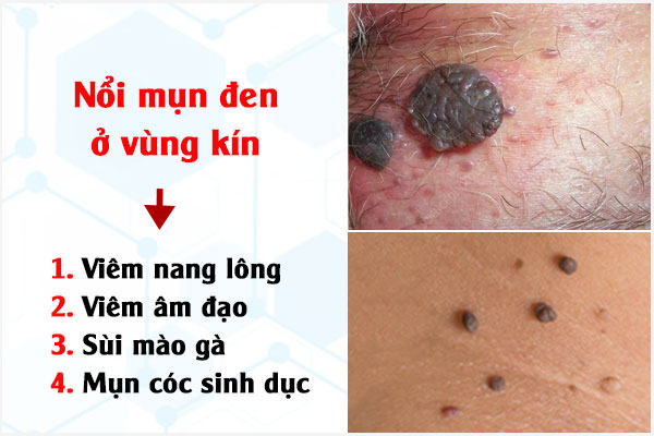 Nổi mụn đen âm đạo có sao không?