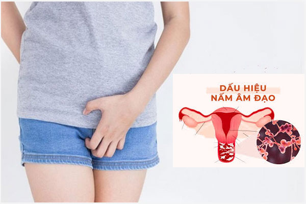 Thuốc điều trị nấm âm đạo loại nào dùng hiệu quả? Mua ở đâu?